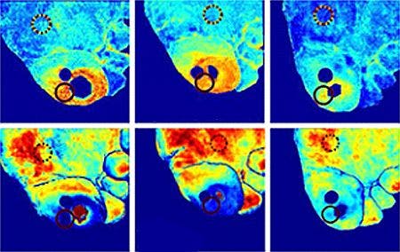 Hyperspectral imaging helps diagnose ulcers