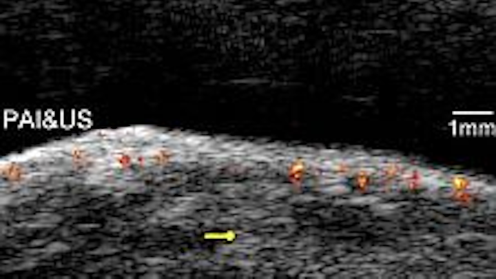 Triple imaging technique looks promising for early ovarian cancer diagnosis