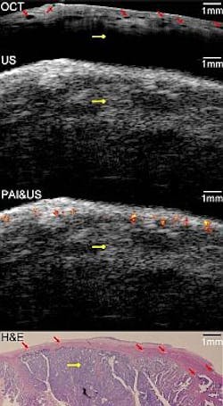 Triple imaging technique looks promising for early ovarian cancer diagnosis Triple imaging technique looks promising for early ovarian cancer diagnosis