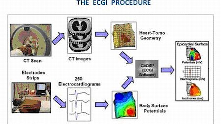 Electrocardiographic imaging (ECGI) can help locate the source of a dangerous cardiac arrhythmia called ventricular tachycardia (VT)