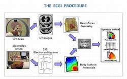 Electrocardiographic imaging (ECGI) can help locate the source of a dangerous cardiac arrhythmia called ventricular tachycardia (VT) Electrocardiographic imaging (ECGI) can help locate the source of a dangerous cardiac arrhythmia called ventricular tachycardia (VT)