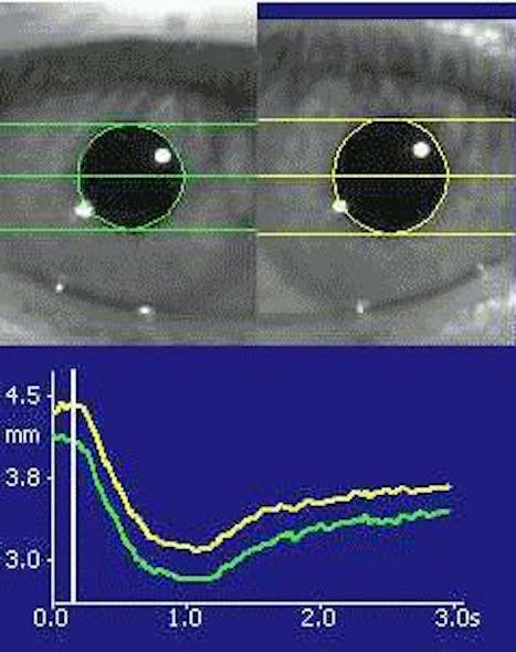 NeurOptics Pupillometer infrared eye test enables more objective neurological diagnoses