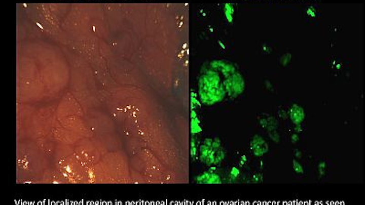 Multispectral technique combines with fluorescing agent for targeted cancer surgery