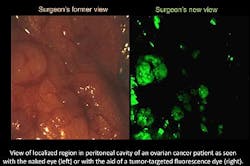 Multispectral technique combines with fluorescing agent for targeted cancer surgery Multispectral technique combines with fluorescing agent for targeted cancer surgery