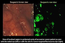 Multispectral technique combines with fluorescing agent for targeted cancer surgery