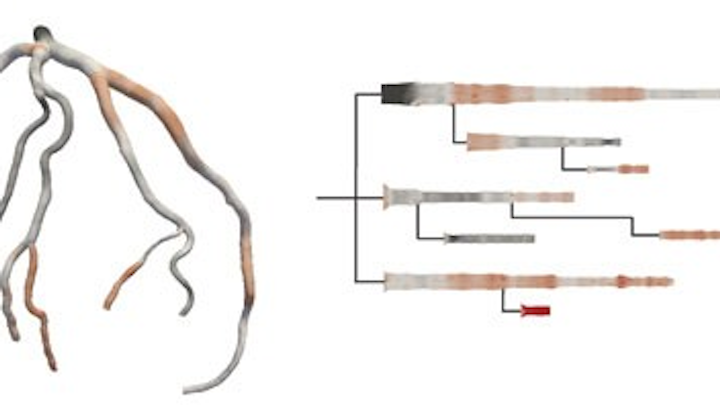 A team at Harvard has developed a 2-D method of visualizing human arteries, called HemoVis, that may result in more accurate diagnoses of atherosclerosis and heart disease. Image courtesy of Michelle Borkin.