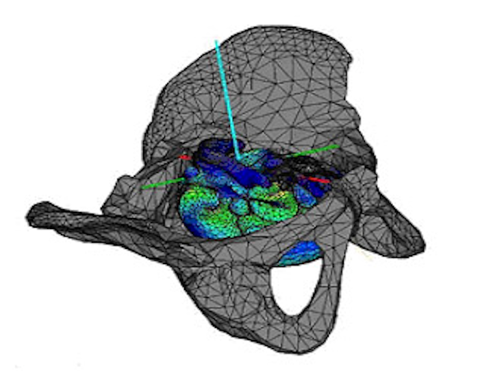 Predibirth software analyzes MRIs to determine whether a woman will have a diffult childbirth