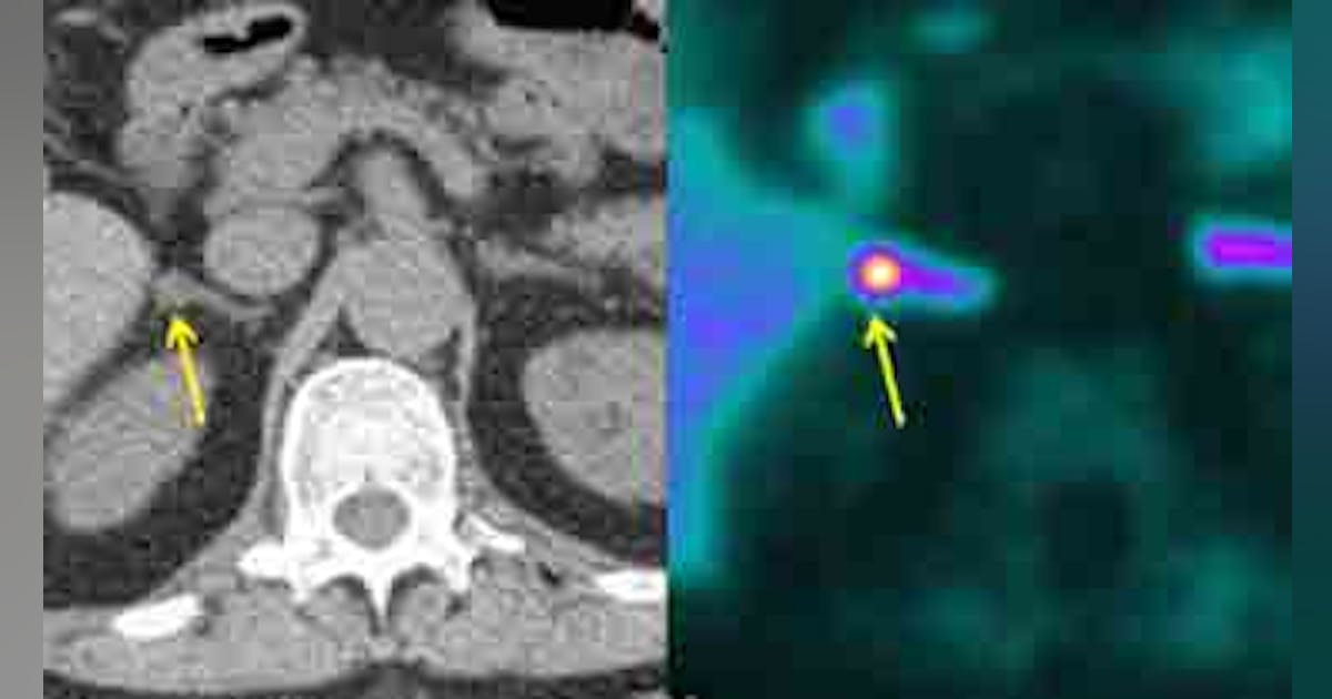Imaging system can help pinpoint blood pressure problem | Vision ...