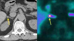 PET-CT scan test uses radioactive tracer to locate adenomas that can cause hypertension. Image credit: Morris Brown