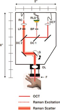 A noninvasive probe combines Raman spectroscopy and OCT to characterize skin cancers A noninvasive probe combines Raman spectroscopy and OCT to characterize skin cancers
