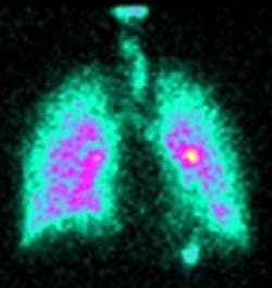 3-D imaging helps lung disease sufferers 3-D imaging helps lung disease sufferers