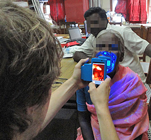 Smartphone system helps diagnose oral cancer