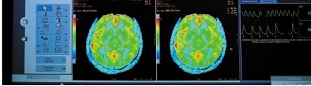 MRI maps the development of the brain