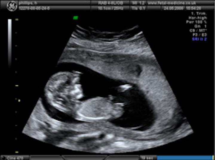 3 D Ultrasound Software Company Spins Out Of Oxford Vision