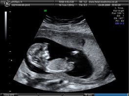 3-D ultrasound software company spins out of Oxford