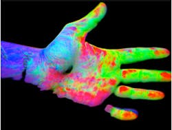 Imaging system to help diagnose psoriasis Imaging system to help diagnose psoriasis