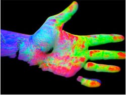 Imaging system to help diagnose psoriasis