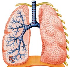 CT scan technique differentiates types of lung damage CT scan technique differentiates types of lung damage