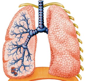 CT scan technique differentiates types of lung damage