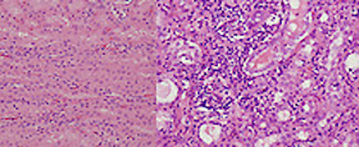 Software classifies histopathological images