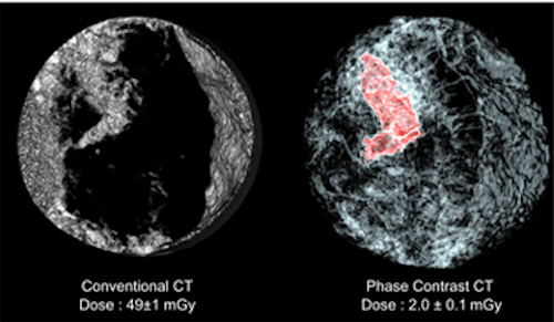 Low dose X-ray system aids breast disease diagnosis