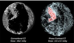 Low dose X-ray system aids breast disease diagnosis Low dose X-ray system aids breast disease diagnosis