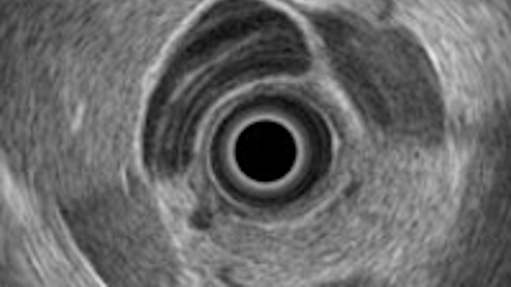 Analyzing ultrasound helps diagnose cancerous tissue