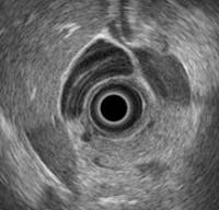 Analyzing ultrasound helps diagnose cancerous tissue