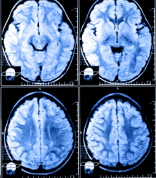 Software analyzes MRI scans
