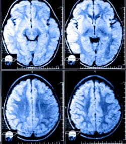Software analyzes MRI scans Software analyzes MRI scans