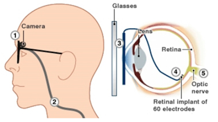 Farsighted engineer gives second sight to the blind