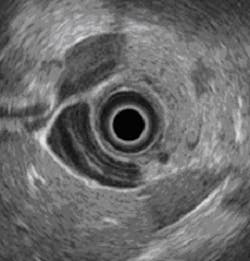 Ultrasound images from a pill Ultrasound images from a pill