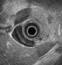 Ultrasound images from a pill