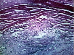 Artery walls imaged in vivo Artery walls imaged in vivo