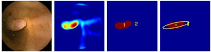 Content Dam Vsd Online Articles 2013 05 Polyp Detection