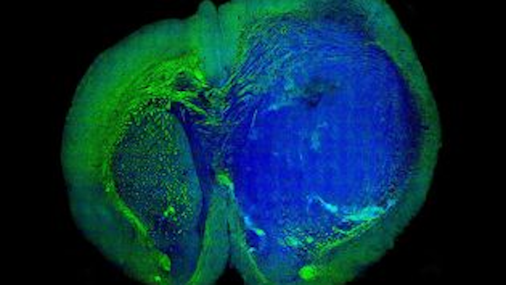Content Dam Vsd Online Articles 2013 09 Brain Tumors Copy
