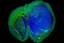 Content Dam Vsd Online Articles 2013 09 Brain Tumors Copy Content Dam Vsd Online Articles 2013 09 Brain Tumors Copy