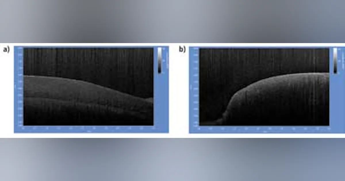 MEDICAL IMAGING: OCT provides nondestructive testing at high resolution ...