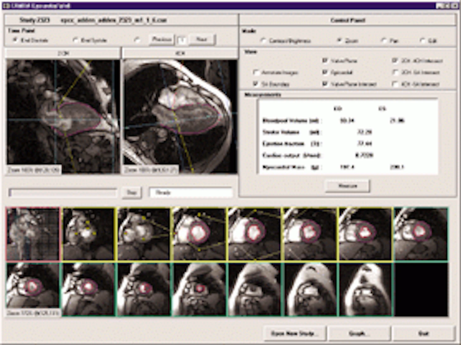 MRI software analyzes heart functions | Vision Systems Design