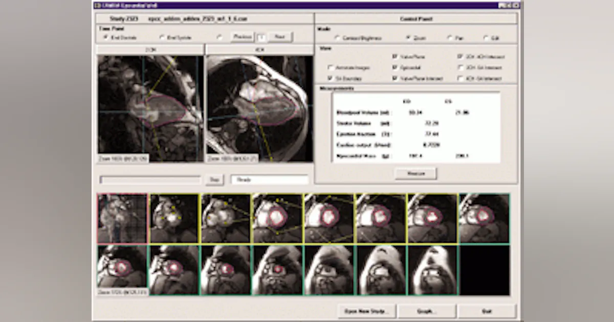 MRI software analyzes heart functions | Vision Systems Design