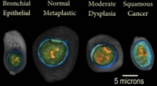Content Dam Vsd En Articles 2013 11 3d Imaging And Analysis Software Detects Lung Cancer In Sputum Cells Leftcolumn Article Thumbnailimage File