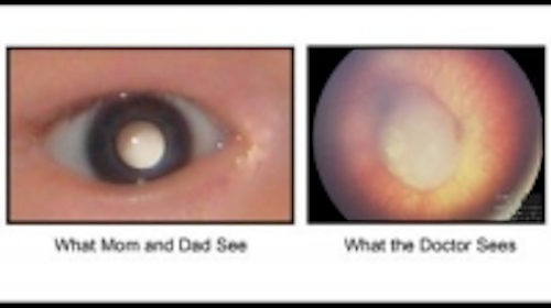 Content Dam Vsd En Articles 2013 11 Page 2 Academic Researchers Working To Create Pediatric Eye Cancer Detection Software Leftcolumn Article Thumbnailimage File