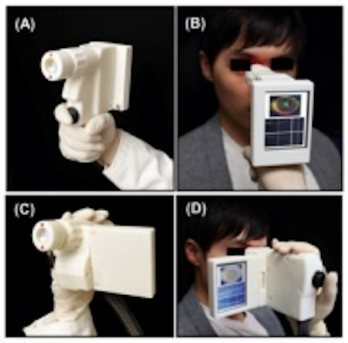 Content Dam Vsd En Articles 2013 12 Mit Develops Hand Held Scanner For Detecting Eye Disease Leftcolumn Article Thumbnailimage File