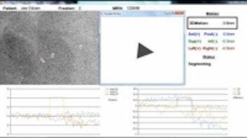 Content Dam Vsd En Articles 2014 01 Imaging Software Tracks Tumor Rotation During Radiotherapy Leftcolumn Article Thumbnailimage File