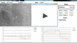 Content Dam Vsd En Articles 2014 01 Imaging Software Tracks Tumor Rotation During Radiotherapy Leftcolumn Article Thumbnailimage File Content Dam Vsd En Articles 2014 01 Imaging Software Tracks Tumor Rotation During Radiotherapy Leftcolumn Article Thumbnailimage File