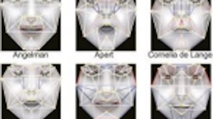 Content Dam Vsd En Articles 2014 06 Computer Vision Algorithms Help Identify Genetic Disorders From Ordinary Photos Leftcolumn Article Thumbnailimage File