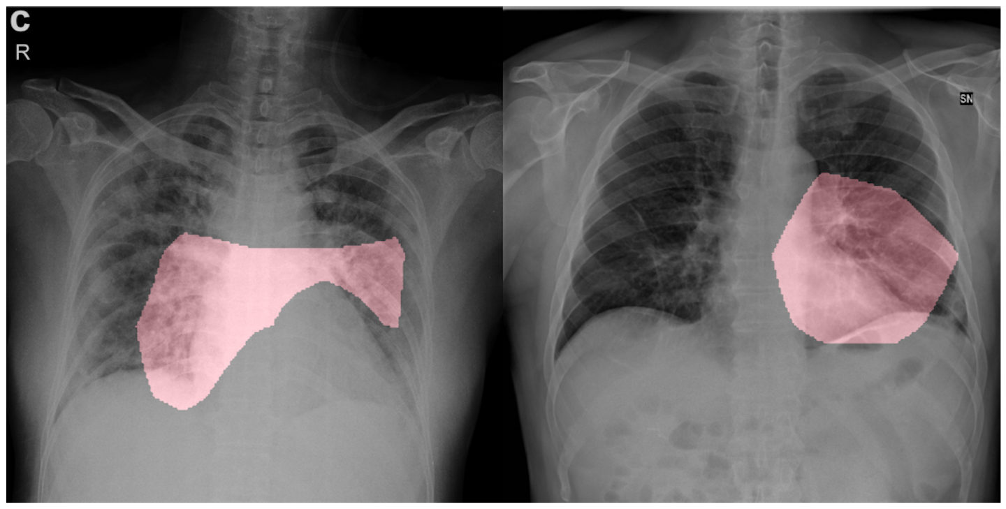 Covid 19 Chest Radiography Deep Learning Virus Detection Vision Systems Design