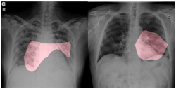 Figure 6: COVID-Net helps identify areas in the lungs as being being critical factors in determining whether an image is a COVID-19 patient.