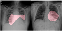 Figure 6: COVID-Net helps identify areas in the lungs as being being critical factors in determining whether an image is a COVID-19 patient. Figure 6: COVID-Net helps identify areas in the lungs as being being critical factors in determining whether an image is a COVID-19 patient.