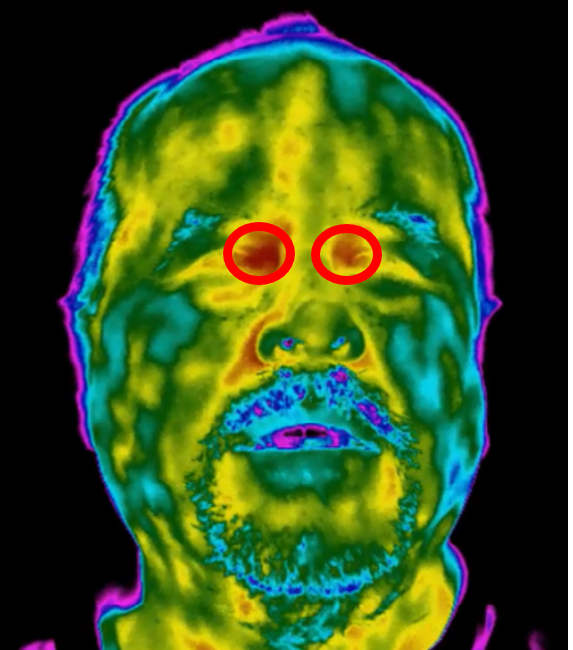 Figure 2: The tear duct region of the face (inner canthus) offers the most accurate part of the face when it comes to optical temperature measurement
